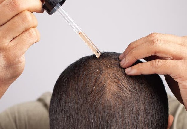 Mesoterapie vir die behandeling van haarverlies by mans