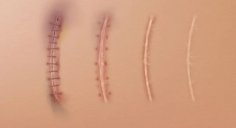 The duration of suture wound healing
