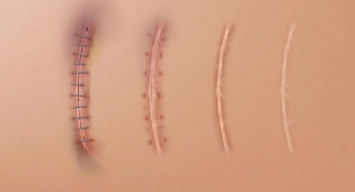 The duration of suture wound healing