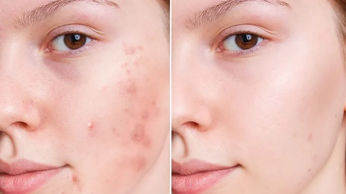 What kind of detergent should we apply acne cream with?