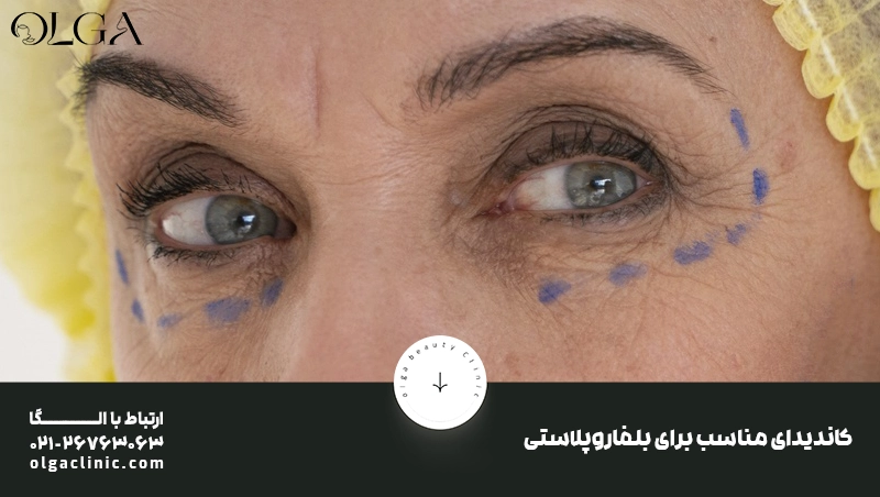 کاندیدای مناسب برای بلفاروپلاستی